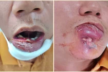 Tự điều trị mụn, quý ông 40 tuổi nhập viện vì áp xe sưng to vùng môi