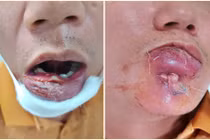 Tự điều trị mụn, quý ông 40 tuổi nhập viện vì áp xe sưng to vùng môi