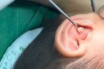 Trẻ 5 tuổi nhét sỏi vào tai, đi hai bệnh viện mới lấy được