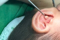 Trẻ 5 tuổi nhét sỏi vào tai, đi hai bệnh viện mới lấy được