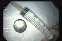 Đi khám ho sốt không ngờ pin cúc gây loét thực quản