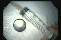 Đi khám ho sốt không ngờ pin cúc gây loét thực quản