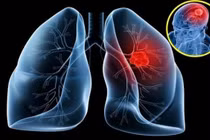 Ung thư phổi di căn não nguy hiểm thế nào?