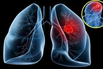 Ung thư phổi di căn não nguy hiểm thế nào?