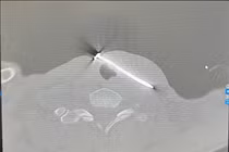 Căng dây cước, người đàn ông 49 tuổi bị đinh sắt cắm sâu vào giữa cổ