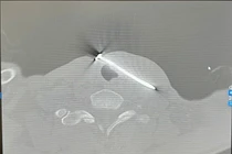 Căng dây cước, người đàn ông 49 tuổi bị đinh sắt cắm sâu vào giữa cổ