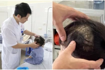 Ngã cầu thang trong lúc chơi bé 3 tuổi tụ máu não, cảnh báo tai nạn sinh hoạt