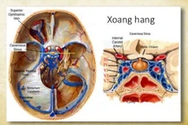 Chủ quan hắt hơi, sổ mũi người bệnh nguy kịch vì tắc tĩnh mạch xoang hang