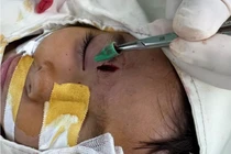 Bút bi gãy bị bỏ quên 5 ngày trong hố mắt trẻ