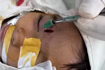 Bút bi gãy bị bỏ quên 5 ngày trong hố mắt trẻ