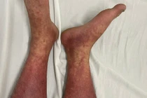 Cảnh báo khẩn, thuốc cấm Phenylbutazone bán tràn lan, nhiều người nguy kịch