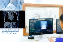 Ho kéo dài không có triệu chứng, không ngờ u 'khổng lồ' chiếm chỗ lồng ngực