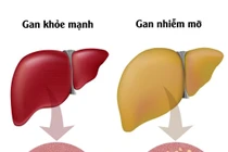 Loại đồ uống tốt cho người gan nhiễm mỡ