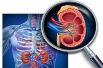 Dấu hiệu nhận biết sớm viêm cầu thận đừng bỏ qua