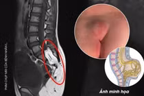 10 tuổi bỗng nhiên đái dầm đi khám không ngờ dị tật tủy sống