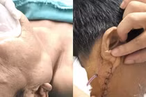 Hình ảnh khối u trước và sau mổ - Ảnh BVCC