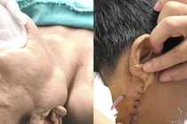 Hình ảnh khối u trước và sau mổ - Ảnh BVCC