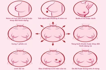 Phồng rộp do dán cao lên u vú, người phụ nữ 44 tuổi được chẩn đoán ung thư