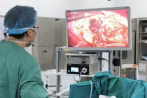 Người phụ nữ suýt vỡ nang gan khổng lồ gần 9cm