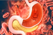 Đi ngoài phân đen, không ngờ bệnh di truyền rối loạn huyết học