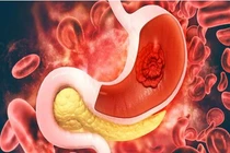 Đi ngoài phân đen, không ngờ bệnh di truyền rối loạn huyết học