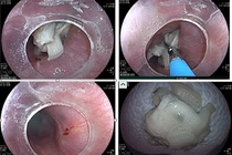 Liên tiếp 3 ca nuốt dị vật nguy hiểm, bác sĩ cảnh báo
