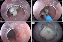 Liên tiếp 3 ca nuốt dị vật nguy hiểm, bác sĩ cảnh báo
