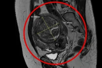Nút mạch u xơ tử cung to như thai 6 tháng ở người phụ nữ tưởng bệnh mãn kinh