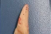 Tai nạn xe đạp điện, trẻ 10 tuổi phải mổ lấy dị vật răng trong đường thở