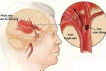 Sự thực về "nắng nóng tăng 1 độ, tăng 10% nguy cơ đột quỵ"?