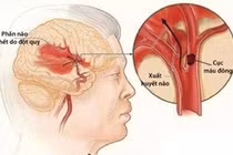 Địa chỉ vàng: Các bệnh viện cấp cứu đột quỵ hàng đầu tại Hà Nội