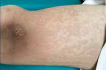 Ăn ve sầu, thanh niên 17 tuổi cấp cứu vì sốc phản vệ