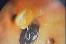 Ho, khó thở kéo dài do hạt hồng xiêm trú ngụ 4 tháng trong phế quản