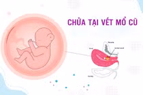 Chửa trên vết mổ cũ, thai vỡ máu tràn ổ bụng nguy kịch