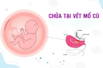 Chửa trên vết mổ cũ, thai vỡ máu tràn ổ bụng nguy kịch
