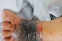 Đắp thuốc nam chữa vết mèo cắn, bé trai 4 tuổi nguy kịch