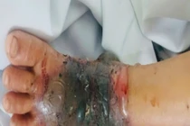 Đắp thuốc nam chữa vết mèo cắn, bé trai 4 tuổi nguy kịch