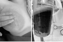 Mẹ trẻ áp xe vú phải mổ vì không biết cách chăm sóc, cho con bú đúng