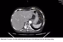 Nhiều người viêm phúc mạc do thủng tạng rỗng vì bỏ qua triệu chứng