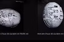 Sửa hẹp sọ bẩm sinh phục hồi diện mạo, bảo vệ não bộ cho trẻ