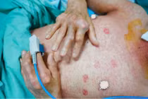 Mắc hội chứng Stevens - Johnson nguy kịch do uống thuốc nam 