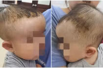 Bé 7 tháng tuổi tụ máu đầu nguy hiểm do ngã giường