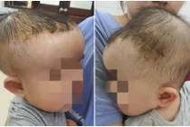 Bé 7 tháng tuổi tụ máu đầu nguy hiểm do ngã giường