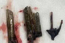 Phải làm hậu môn nhân tạo vì chủ quan cây đâm cạnh hậu môn