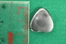 Vui chơi tại nhà, bé 6 tuổi nuốt phải nam châm hình trái tim