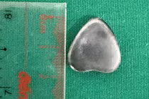 Vui chơi tại nhà, bé 6 tuổi nuốt phải nam châm hình trái tim