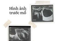 Chủ quan đau bụng, người phụ nữ 41 tuổi xoắn tử cung hiếm gặp