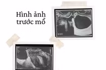 Chủ quan đau bụng, người phụ nữ 41 tuổi xoắn tử cung hiếm gặp