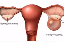 U nang buồng trứng khổng lồ chiếm toàn bộ ổ bụng người phụ nữ 43 tuổi