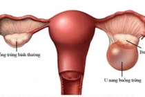 U nang buồng trứng khổng lồ chiếm toàn bộ ổ bụng người phụ nữ 43 tuổi